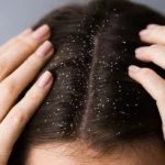 dandruff_hair_loss