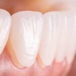 Porcelain Veneers for Your Face Shape