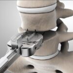 How Spinal Disc Replacement Helps Restore Mobility and Quality of Life